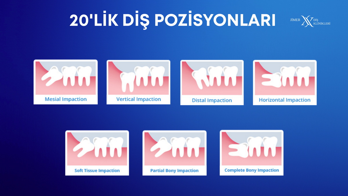 20’lik Dişler Ağız İçinde Nasıl Konumlanır?