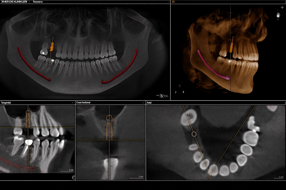 Dental Tomografinin Kullanım Alanları