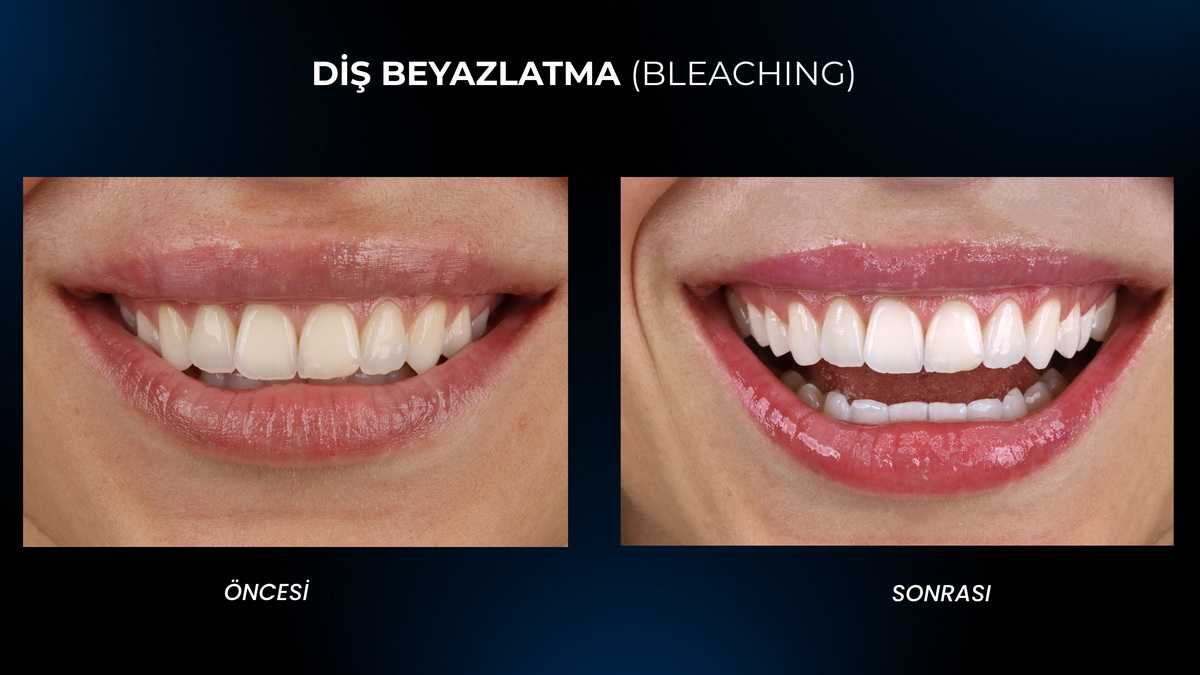 Bursa Diş Beyazlatma (Dental Bleaching)
