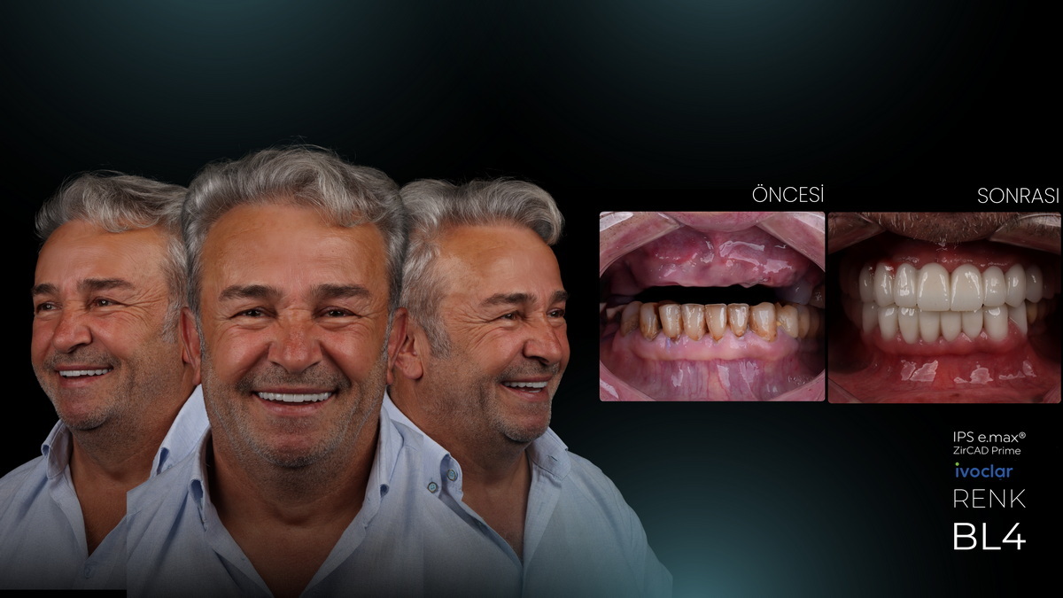 Kişiye Özel Gülüş Estetiği ve Artan Özgüven