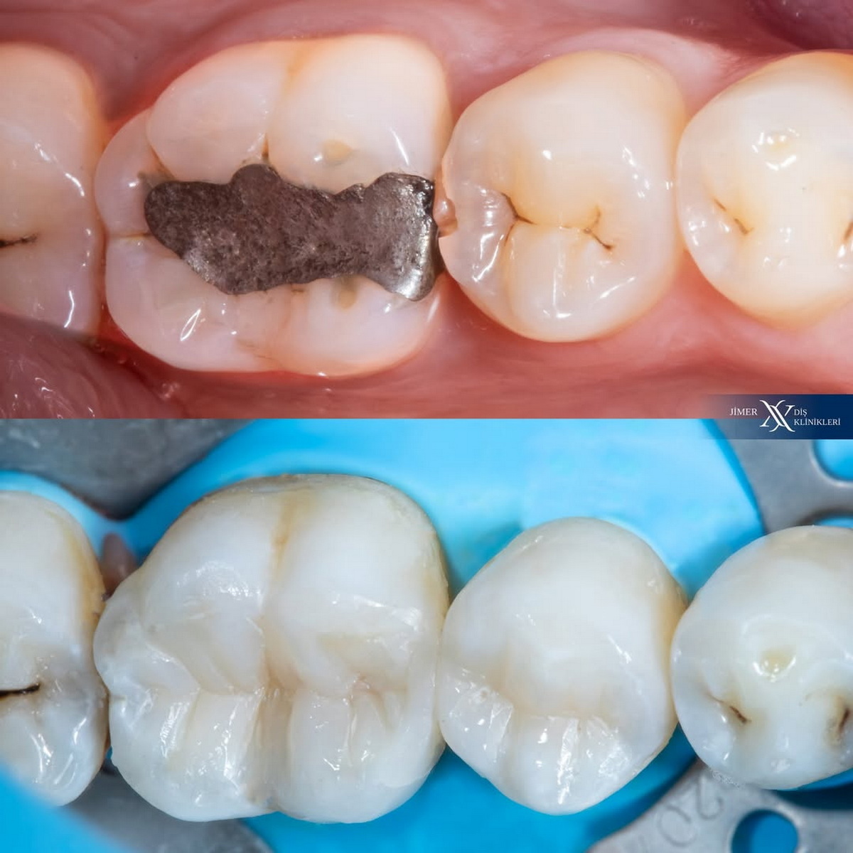 Gri Renkli Dolgular Neden Sağlık Açısından Tehlikeli Olabilir?