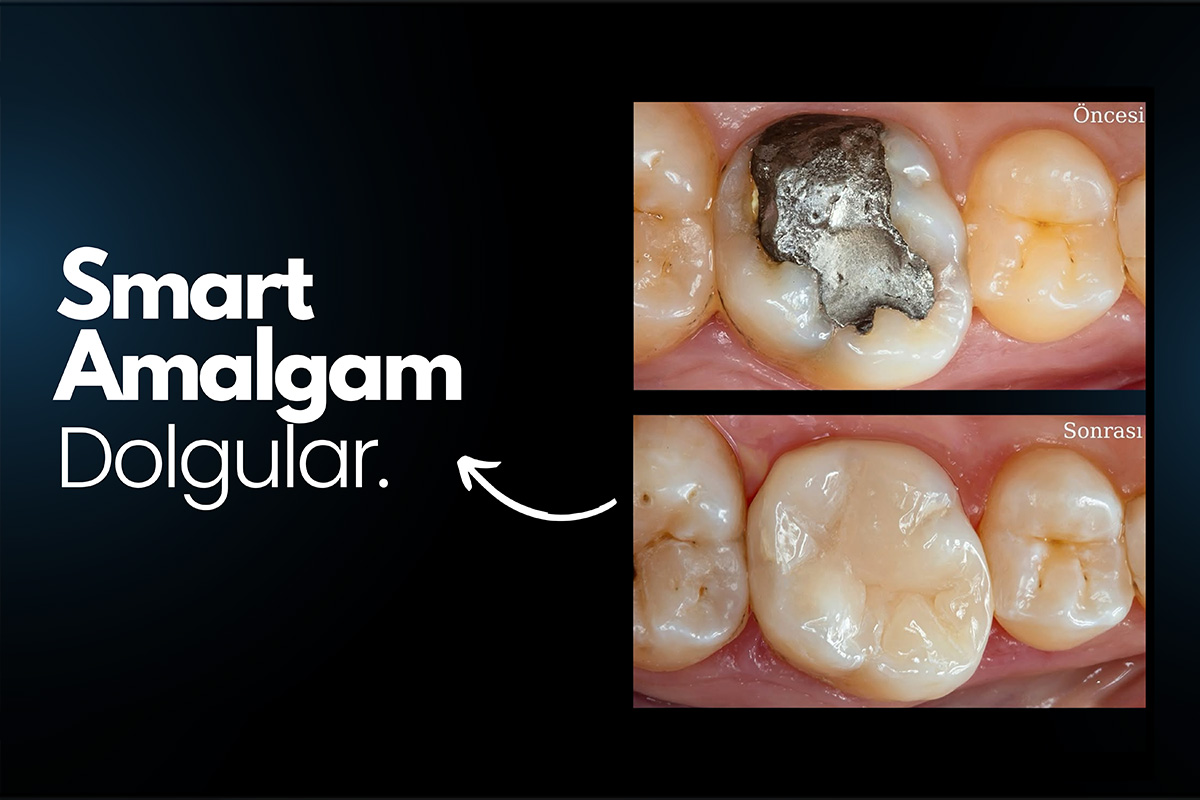 Smart Amalgam Protokolü